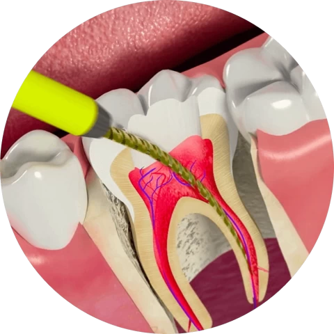 Баннер Лечение пульпита, периодонтита и каналов зуба в Санкт-Петербурге